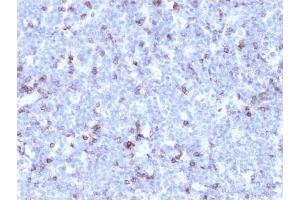 Formalin-fixed, paraffin-embedded human Lymphoma stained with CD43 Mouse Recombinant Monoclonal Antibody (rSPN/1094).