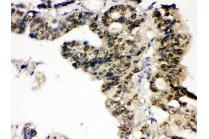 Anti- TCPTP Picoband antibody,IHC(P) IHC(P): Human Intestinal Cancer Tissue