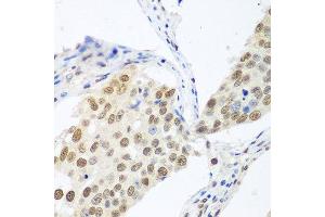 Immunohistochemistry of paraffin-embedded human lung cancer using BCAS2 antibody at dilution of 1:100 (40x lens). (BCAS2 anticorps)