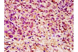 IHC image of ABIN7149816 diluted at 1:200 and staining in paraffin-embedded human ovarian cancer performed on a Leica BondTM system.