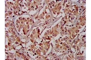IHC image of ABIN7167474 diluted at 1:400 and staining in paraffin-embedded human liver cancer performed on a Leica BondTM system.