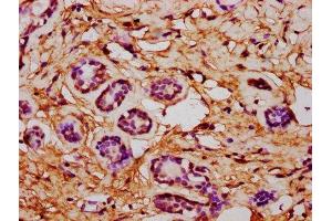 IHC image of ABIN7149034 diluted at 1:600 and staining in paraffin-embedded human breast cancer performed on a Leica BondTM system.