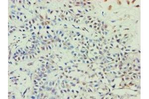 Immunohistochemistry of paraffin-embedded human breast cancer using ABIN7144924 at dilution of 1:100 (ABCE1 anticorps  (AA 320-599))