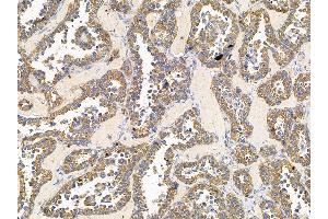 ABIN7095762 and ABIN7099824 at 1/100 staining human ovarian cancer by IHC-P. (ARFGEF1 anticorps)