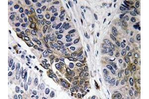 Immunohistochemistry analyzes of IgA antibody in paraffin-embedded human lung carcinoma tissue. (Lapin anti-Humain IgA Anticorps)