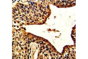 IHC analysis of FFPE human prostate carcinoma with VIP antibody (Vip anticorps  (AA 139-167))
