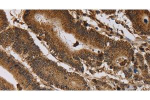 Immunohistochemistry of paraffin-embedded Human colon cancer tissue using ITPR3 Polyclonal Antibody at dilution 1:40 (ITPR3 anticorps)