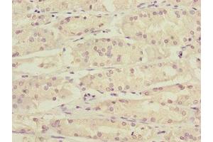 Immunohistochemistry of paraffin-embedded human gastric cancer using ABIN7157720 at dilution of 1:100 (KLF15 anticorps  (AA 1-260))