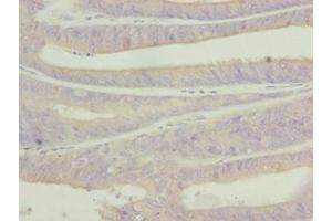Immunohistochemistry of paraffin-embedded human endometrial cancer using ABIN7174916 at dilution of 1:100 (C9orf43 anticorps  (AA 267-461))