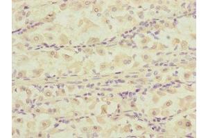 Immunohistochemistry of paraffin-embedded human gastric cancer using ABIN7150823 at dilution of 1:100 (DCTN6 anticorps  (AA 1-190))