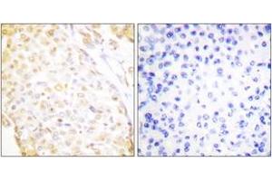Immunohistochemistry analysis of paraffin-embedded human breast carcinoma, using NKX3. (NKX3-1 anticorps  (AA 1-50))