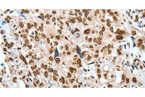 Immunohistochemistry of paraffin-embedded Human esophagus cancer using BNIP1 Polyclonal Antibody at dilution of 1:60 (BNIP1 anticorps)