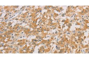 Immunohistochemistry of paraffin-embedded Human thyroid cancer tissue using ZWINT Polyclonal Antibody at dilution 1:50 (ZWINT anticorps)