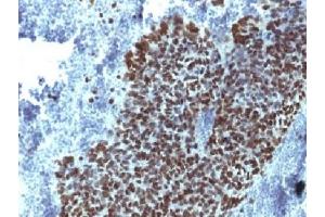 IHC testing of FFPE human prostate carcinoma with FOXA1 antibody (clone FOXA1/1514). (FOXA1 anticorps  (AA 372-472))