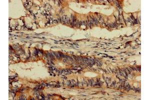 IHC image of ABIN7174001 diluted at 1:1200 and staining in paraffin-embedded human colon cancer performed on a Leica BondTM system.