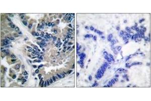 Immunohistochemistry analysis of paraffin-embedded human lung carcinoma tissue, using STAT2 (Ab-690) Antibody. (STAT2 anticorps  (AA 656-705))