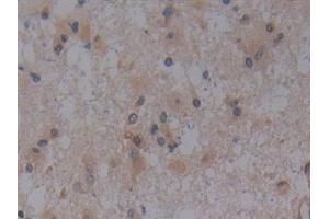 Detection of TLR9 in Human Glioma Tissue using Polyclonal Antibody to Toll Like Receptor 9 (TLR9)