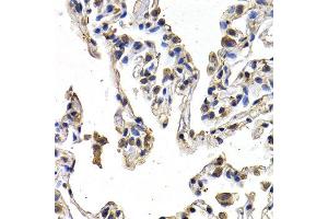 Immunohistochemistry of paraffin-embedded human lung cancer using FIGF antibody at dilution of 1:200 (400x lens). (VEGFD anticorps)