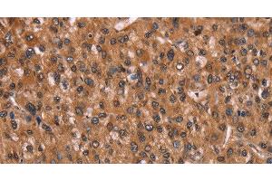 Immunohistochemistry of paraffin-embedded Human liver cancer using HINT1 Polyclonal Antibody at dilution of 1:30