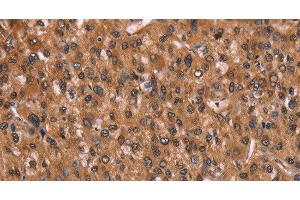 Immunohistochemistry of paraffin-embedded Human liver cancer using HINT1 Polyclonal Antibody at dilution of 1:30 (HINT1 anticorps)