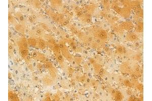 ABIN6257975 and ABIN6274289 at 1/100 staining human hepatocellular carcinoma by IHC-P. (MAPK10 anticorps  (C-Term))