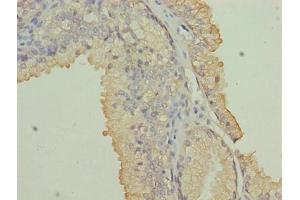 Immunohistochemistry of paraffin-embedded human prostate cancer using ABIN7161717 at dilution of 1:100 (NRARP anticorps  (AA 1-114))