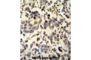C6orf58 antibody (Center) immunohistochemistry analysis in formalin fixed and paraffin embedded human testis carcinoma followed by peroxidase conjugation of the secondary antibody and DAB staining. (C6ORF58 anticorps  (Middle Region))