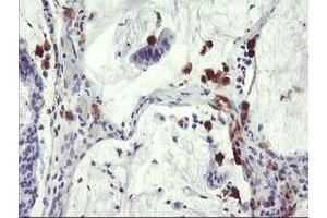 Immunohistochemical staining of paraffin-embedded Adenocarcinoma of Human colon tissue using anti-SDS mouse monoclonal antibody. (serine Dehydratase anticorps)