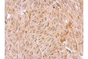 IHC-P Image WDR1 antibody detects WDR1 protein at cytosol on U87 xenograft by immunohistochemical analysis.