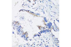 Immunohistochemistry of paraffin-embedded human lung cancer using IKBKE antibody. (IKKi/IKKe anticorps  (AA 495-716))