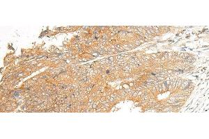 Immunohistochemistry of paraffin-embedded Human colorectal cancer tissue using C5AR2 Polyclonal Antibody at dilution of 1:25(x200) (GPR77 anticorps)