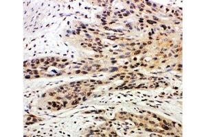 IHC-P: Caspase-14 antibody testing of human esophagus squama cancer tissue (CASP14 anticorps  (AA 223-242))