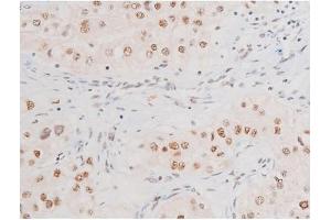 ABIN6267602 at 1/200 staining Human kidney cancer tissue sections by IHC-P.