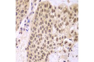 Immunohistochemistry of paraffin-embedded human lung cancer using CSNK2A2 antibody at dilution of 1:100 (400x lens).