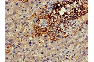 Immunohistochemistry of paraffin-embedded human liver cancer using ABIN7153601 at dilution of 1:100 (GJA8 anticorps  (AA 286-432))