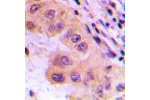 Immunohistochemical analysis of CTPS staining in human liver cancer formalin fixed paraffin embedded tissue section.