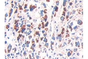 Detection of Hsp60 in Human Stomach cancer Tissue using Polyclonal Antibody to Heat Shock Protein 60 (Hsp60)