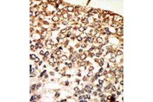Formalin-fixed and paraffin-embedded human cancer tissue reacted with the primary antibody, which was peroxidase-conjugated to the secondary antibody, followed by AEC staining.