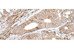 Immunohistochemistry of paraffin-embedded Human colorectal cancer tissue using ENPEP Polyclonal Antibody at dilution of 1:65(x200) (ENPEP anticorps)