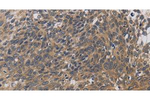 Immunohistochemistry of paraffin-embedded Human cervical cancer using EMC8 Polyclonal Antibody at dilution of 1:30 (COX4NB anticorps)