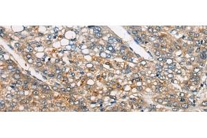 Immunohistochemistry of paraffin-embedded Human liver cancer tissue using CDKL4 Polyclonal Antibody at dilution of 1:45(x200)