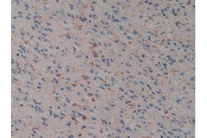 IHC-P analysis of Human Glioma Tissue, with DAB staining. (Prosaposin anticorps  (AA 17-524))