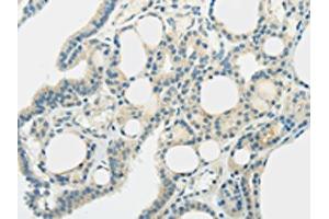 The image on the left is immunohistochemistry of paraffin-embedded Human thyroid cancer tissue using ABIN7192521(SLC7A11 Antibody) at dilution 1/35, on the right is treated with synthetic peptide. (SLC7A11 anticorps)