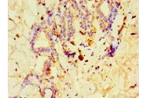 Immunohistochemistry of paraffin-embedded human breast cancer using ABIN7148491 at dilution of 1:100