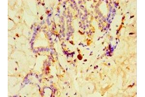 Immunohistochemistry of paraffin-embedded human breast cancer using ABIN7148491 at dilution of 1:100 (GPS1 anticorps  (AA 222-491))