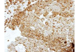 IHC-P Image Immunohistochemical analysis of paraffin-embedded PC14 xenograft, using ENO2, antibody at 1:100 dilution.