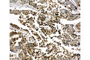 IHC-P: BiP antibody testing of human lung cancer tissue
