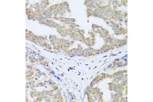 Immunohistochemistry of paraffin-embedded human liver cancer using TIMM10B antibody (ABIN5974609) at dilution of 1/100 (40x lens). (TIMM10B anticorps)