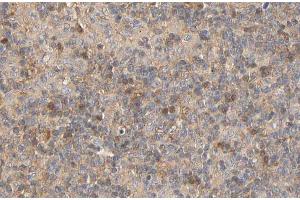 ABIN6267441 at 1/100 staining human Lymphoma tissue sections by IHC-P. (RPS6KB1 anticorps  (pSer424))