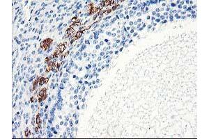 Immunohistochemical staining of paraffin-embedded Adenocarcinoma of Human ovary tissue using anti-ELK3 mouse monoclonal antibody. (ELK3 anticorps)